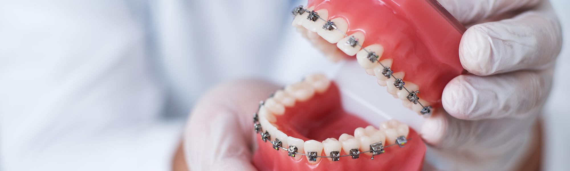 How to Avoid the Most Common Orthodontic Emergencies