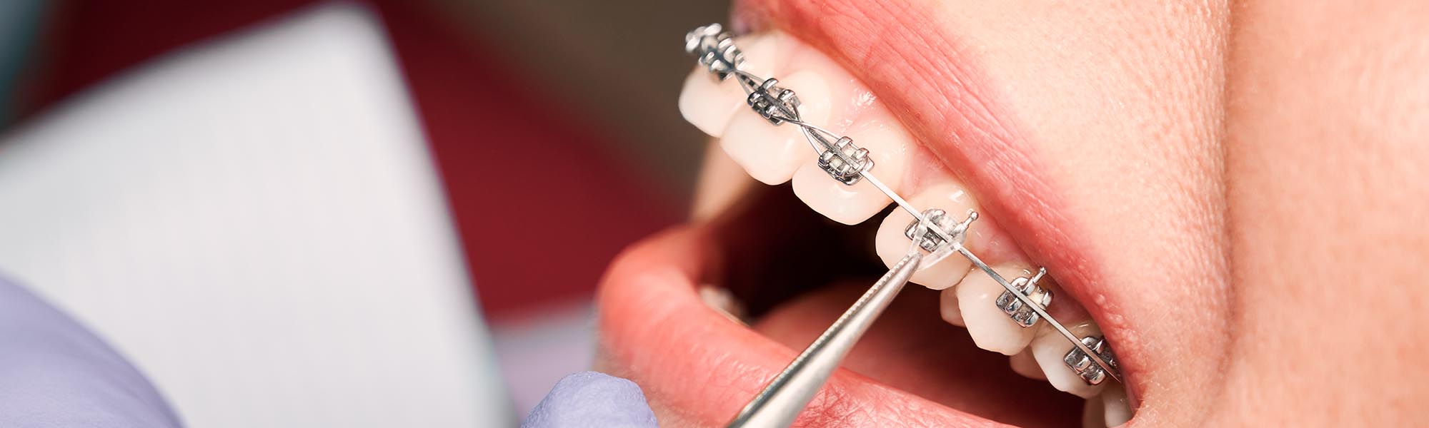 Frequently Asked Questions About Braces and Insurance Coverage