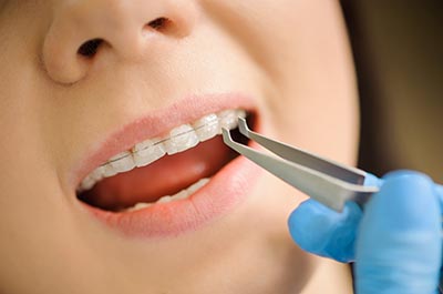 What Are Ceramic Braces?