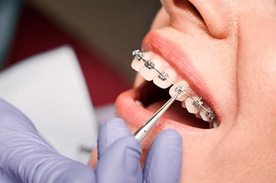 Frequently Asked Questions About Braces and Insurance Coverage
