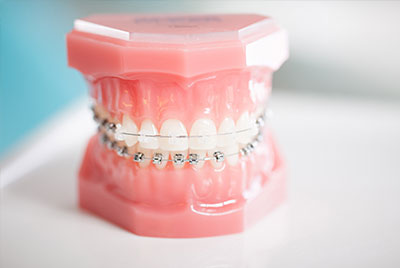Flossing with Braces: 5 Benefits of Taking the Time to Floss Every Day