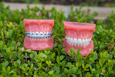 What type of Braces Are Right for Me?