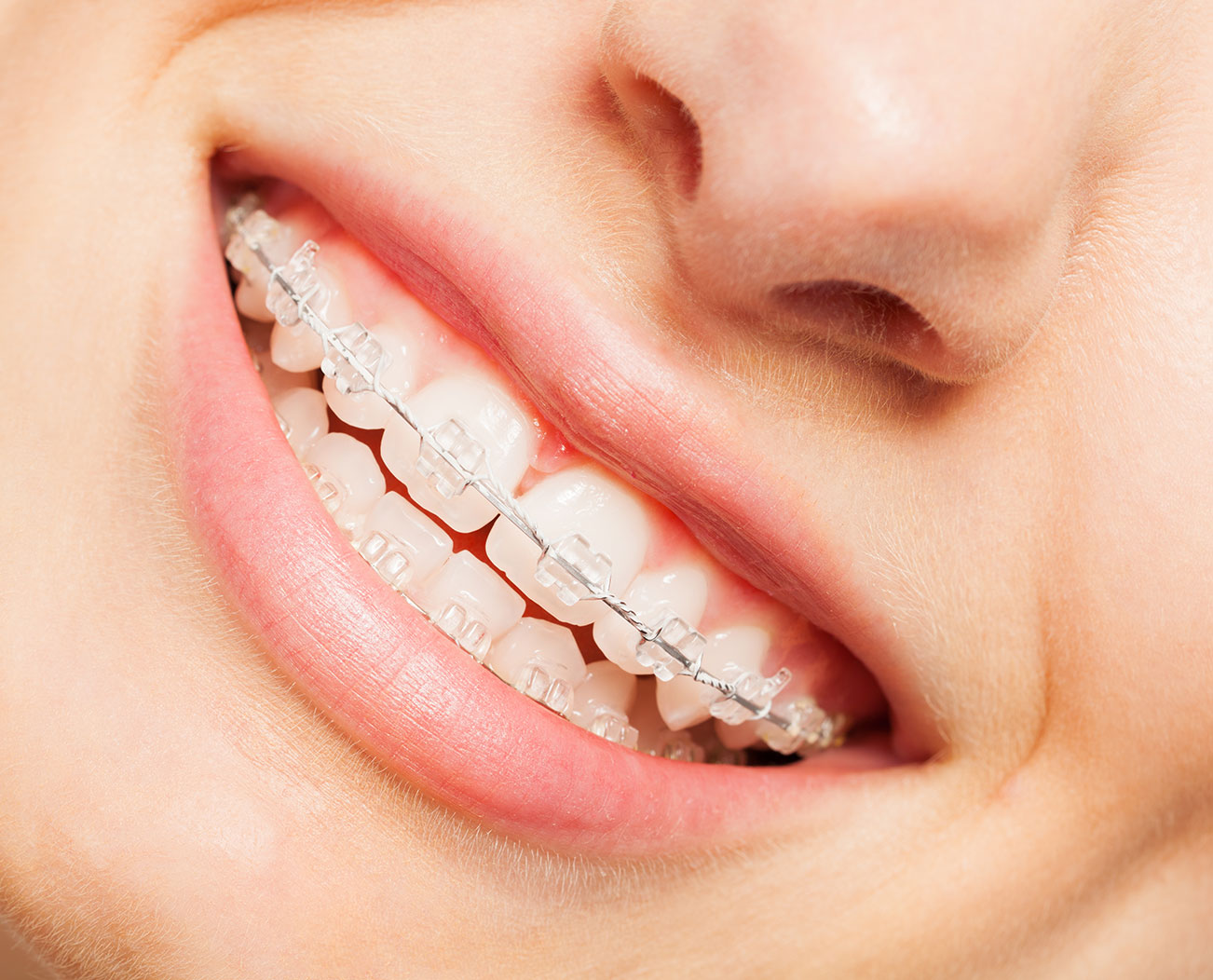 Ceramic Braces Carson CA